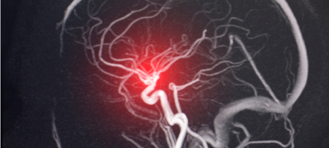 未破裂脳動脈瘤とは