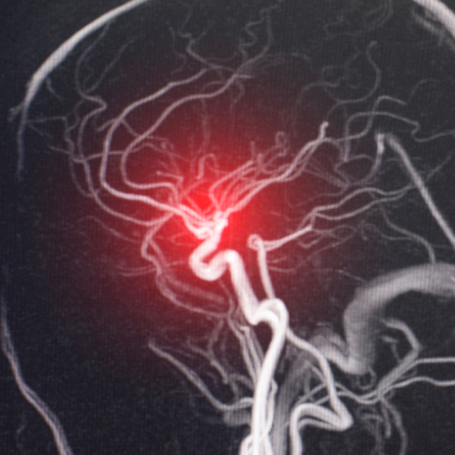 未破裂脳動脈瘤とは
